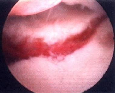 Arthroscopic view demonstrating the articular step