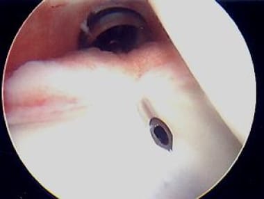 Suture passer device (Spectrum; ConMed Linvatec, L