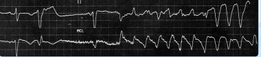 This image demonstrates polymorphic ventricular ta