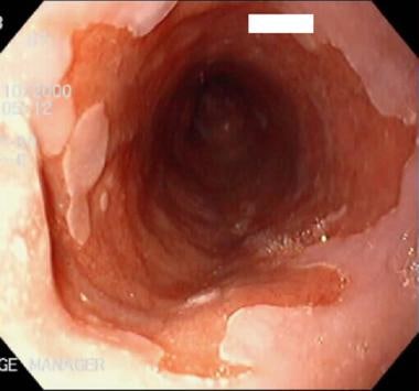 What is the best treatment for Barrett's esophagus?