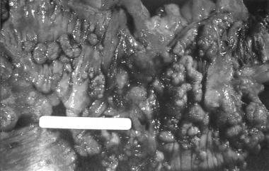 Colectomy specimen obtained from a patient with fa