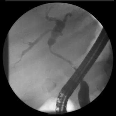 Endoscopic retrograde cholangiopancreatographic ch