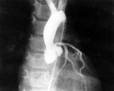 Aortogram of a patient with supravalvar aortic ste