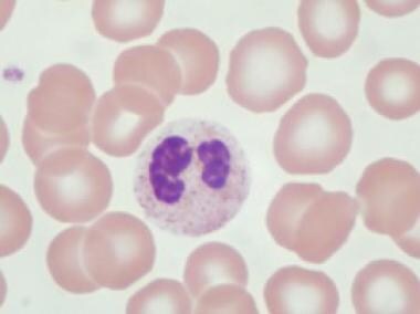 Pathology of therapy-related myeloid neoplasms. Ps
