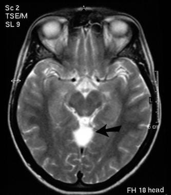 T2-weighted axial MRI image (see previous image fo