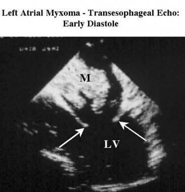 Transesophageal echocardiogram obtained during ear