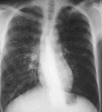 A 27-year-old man diagnosed with reactive airway d