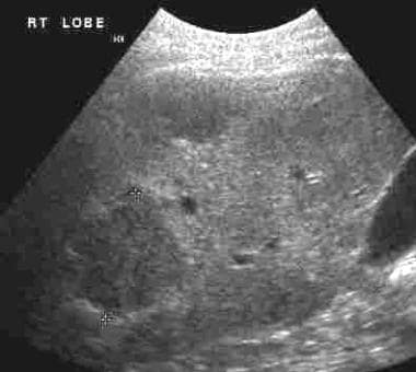 Ultrasound of liver revealing hypoechoic metastasi