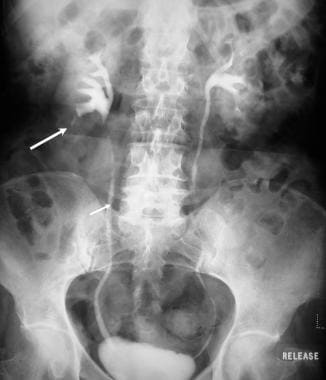 Excretory urography in a patient with renal papill