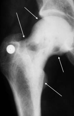 Anteroposterior radiograph of the hip in a patient
