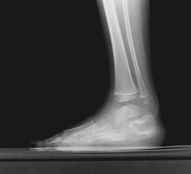 Lateral view of clubfoot shows the nearly parallel
