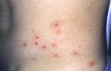 Pseudomonas Folliculitis Clinical Presentation History Physical Examination