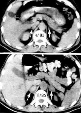 Computed tomographic (CT) scans of the abdomen sho