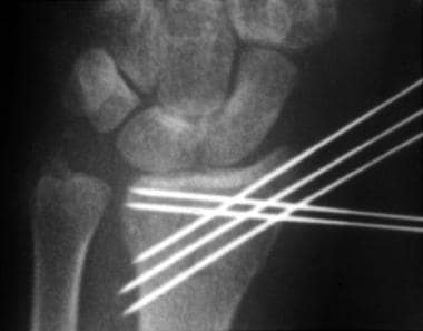 Radiograph of a wrist after arthroscopic-assisted