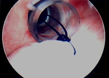 Next, with monofilament suture and all-arthroscopi