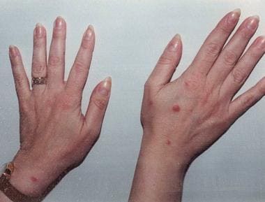 A 40-year-old woman complained of a recurrent skin