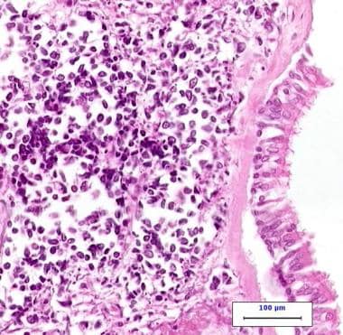 High-power photomicrograph of small cell carcinoma