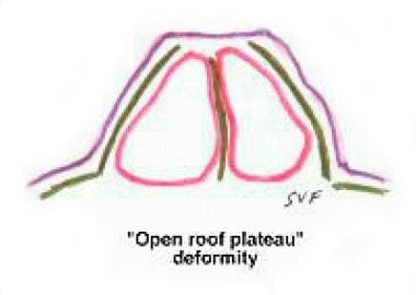 Diagrammatic representation of the "open roof" def