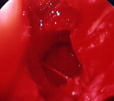 Posterior epistaxis from the left sphenopalatine a