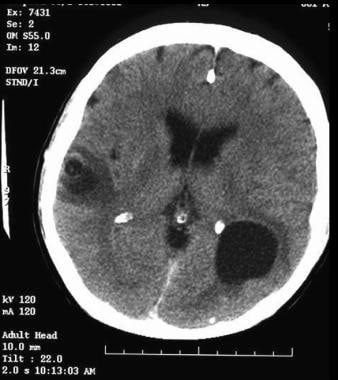 CT scan of intraparenchymal cysticercosis with les