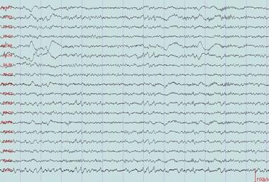 This is a good example of saw tooth waves seen in 