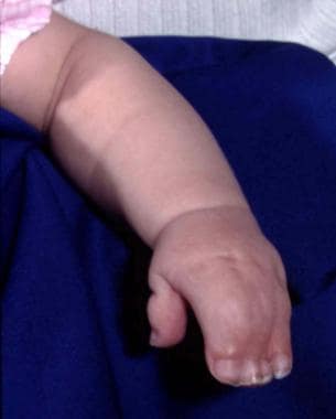 Typical Apert syndrome hand with syndactyly of all