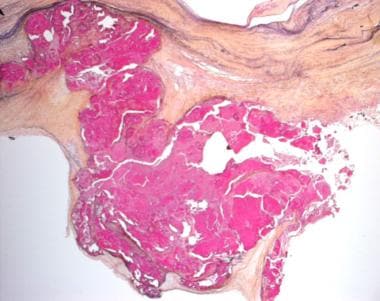 Histologic image of a surgically-excised, congenit