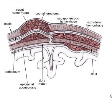 Scalp cross-section and hemorrhage sites. 