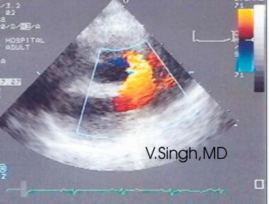 Ventricular septal defect (VSD) as seen by means o