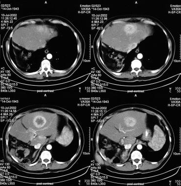 Contrast-enhanced CT scans taken in the portal ven