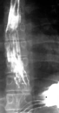 Barium swallow in a 56-year-old man with known cir