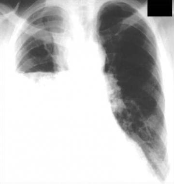 Posteroanterior chest radiograph shows a right-sid