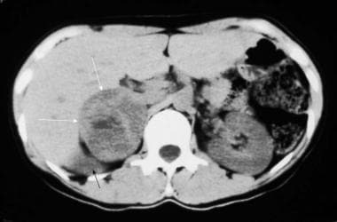 Nonenhanced computed tomography (CT) scan in a 35-