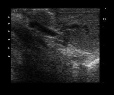 Sonogram depicting a combination of an intratestic