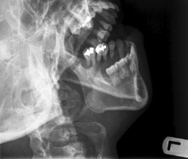 Mandibular Fracture Imaging: Overview, Radiography ...