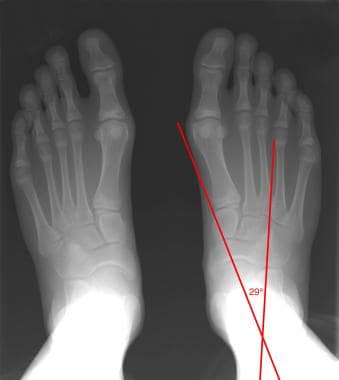 Dorsoplantar projection of a healthy foot shows th