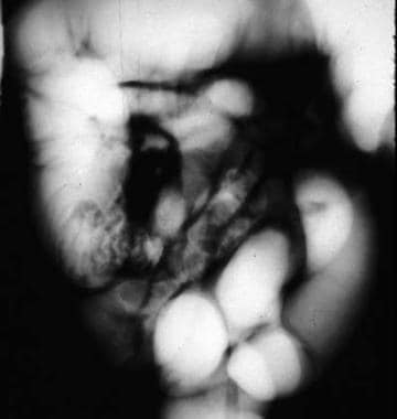 A contrast-reduced intussusception shows backward 
