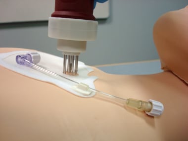 Intraosseous Access Technique: Proximal Tibia Insertion, Automated