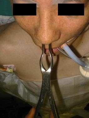 Septal reduction with forceps. 