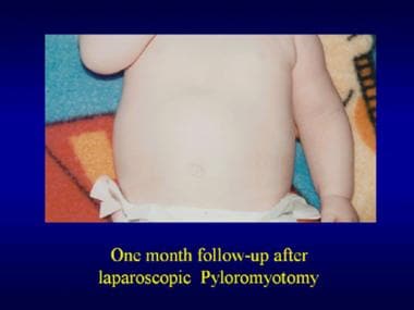 Pyloromyotomy. One month postoperatively after a l