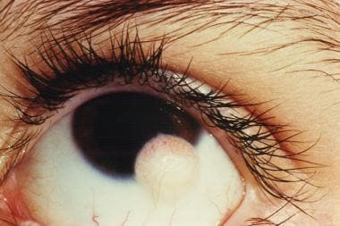 Limbal dermoid in the left eye of a 13-year-old ma