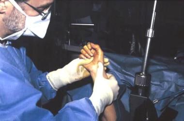 Before the scaphoid is pinned, the wrist is flexed