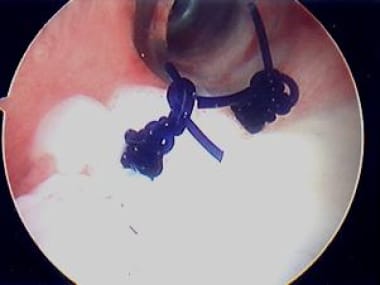 Process in image above is repeated to place second