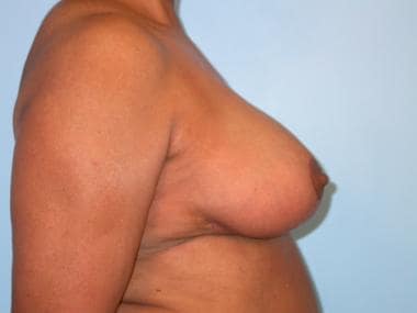 Breast reduction, superomedial pedicle. 2 months p