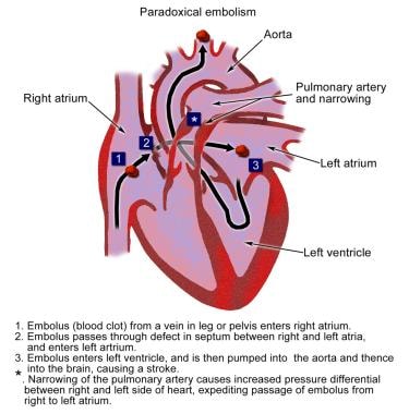 Paradoxical embolism. 