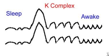 Example of a K complex. 