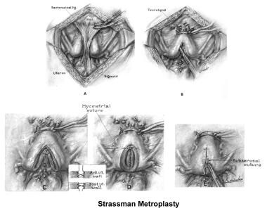 Infertility. Metroplasty - Strassman technique. Im