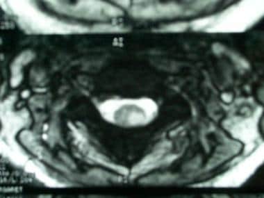 Axial, T2-weighted magnetic resonance image in a w