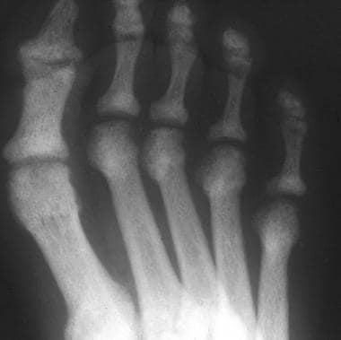 Anteroposterior radiograph of the forefoot in a pa