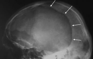 Lateral skull radiograph in a patient with Paget d